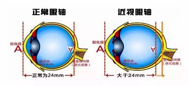 报酬甚么会远视,远视眼构成的道理是甚么