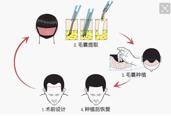发际线为甚么会后移,发际线后移该怎样办